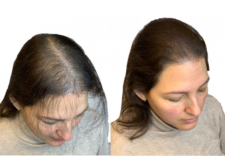 hair transplant for women