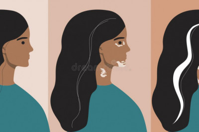 Vitiligo Treatment - Best Medical Specialist in Pakistan