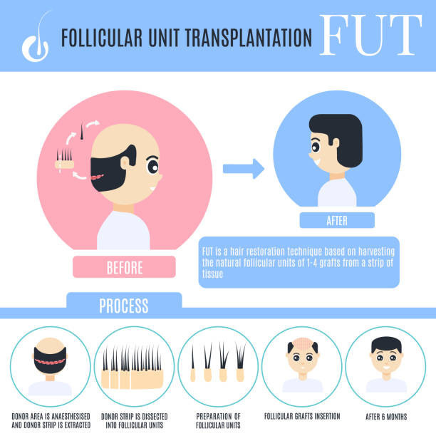 FUE Hair Transplant Near Me in London - LHTC