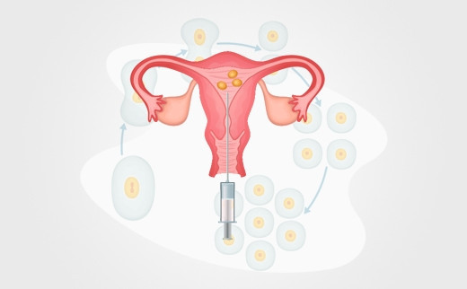 What Are The Advantages And Disadvantages Of IUI?