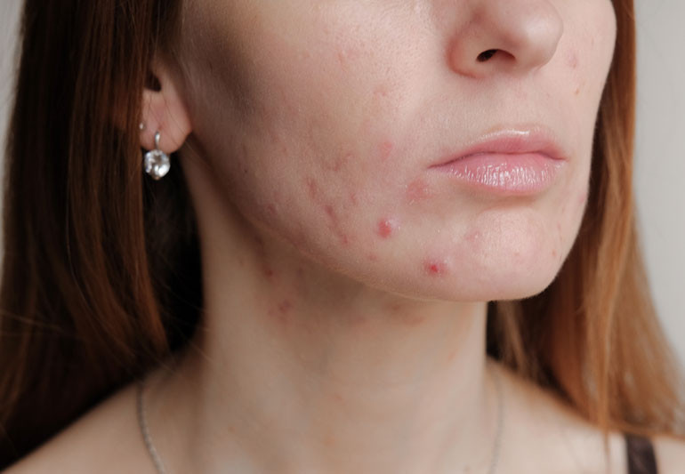 Best Treatment For Acne - Best Acne Treatment In Lahore