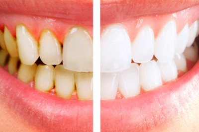 Treats Gum Disease - Best Way to Treat Bleeding Gums