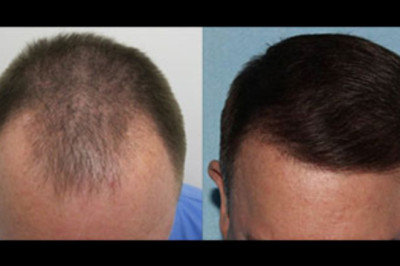 Cuanto Cuesta Un Trasplante De Cabello