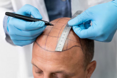 Desglose de transplante capilar fue preço: ¿Vale la pena?